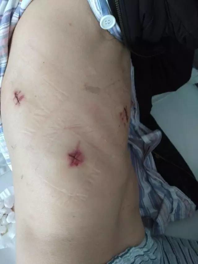 肺疤痕癌最新全面步骤指南，了解、预防与治疗的全攻略